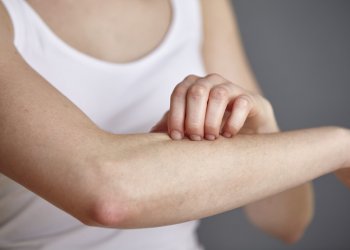 Adultos com dermatite atópica são mais propensos a desenvolver doenças cardiovasculares