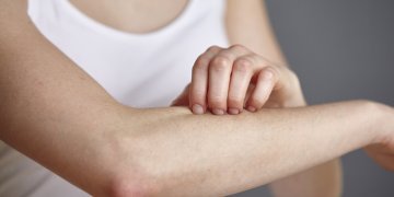 Adultos com dermatite atópica são mais propensos a desenvolver doenças cardiovasculares